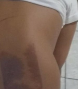 Menina de 7 anos sofre queimadura após dormir em cima de celular