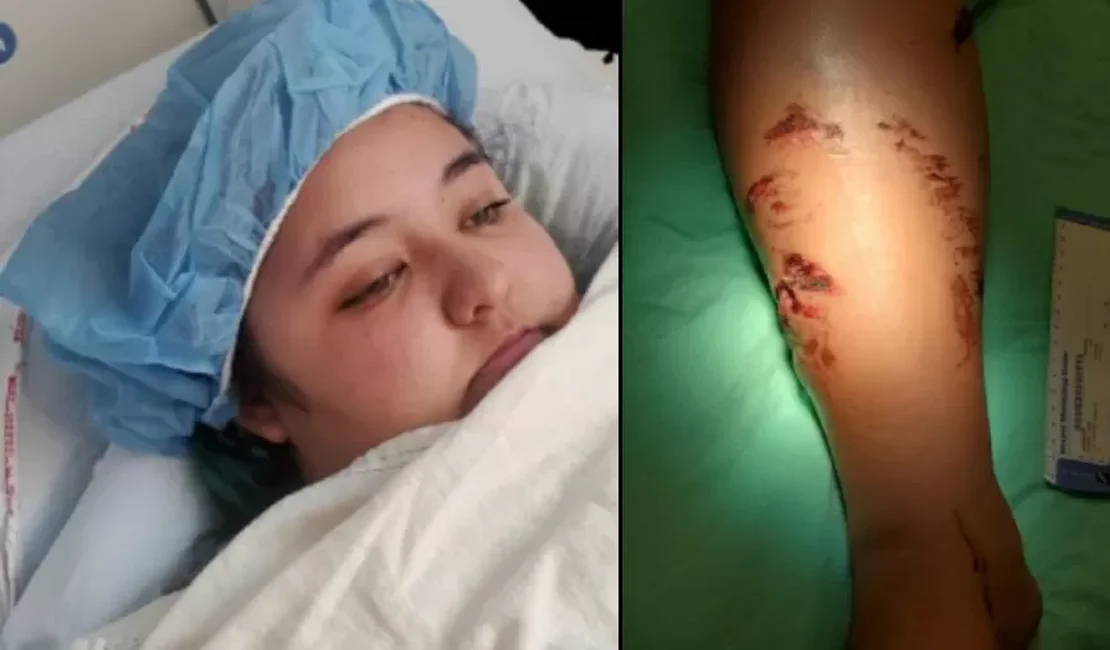 Jovem sobrevive após ser atacada por crocodilo e puxada para debaixo d'água
