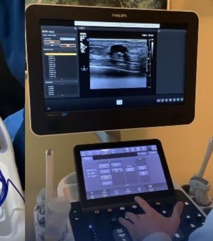 Biópsia a vácuo por ultrassonografia amplia opções de exames mamários em Alagoas