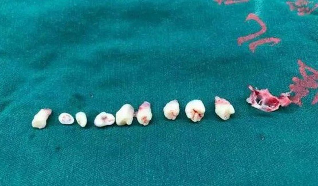 Dentes são removidos de cérebro de menino de 5 anos