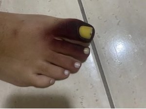 Mulher fica com dedos roxos após ter piolho-de-cobra preso no tênis
