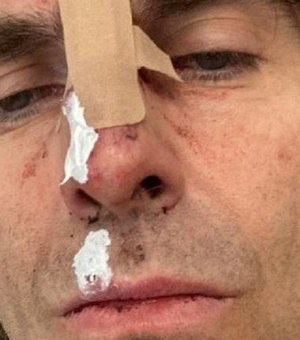 Liam Gallagher mostra rosto machucado depois de cair de helicóptero após show