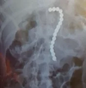 Menino de 2 anos é hospitalizado após engolir 16 esferas magnéticas