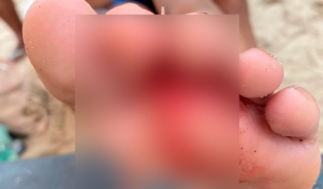 Criança tem pé perfurado por espinha de peixe em praia de Maceió