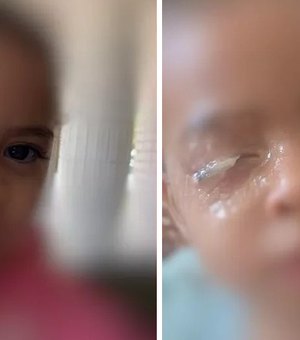 Menina de 2 anos vai parar no hospital após grudar olho com cola, no DF