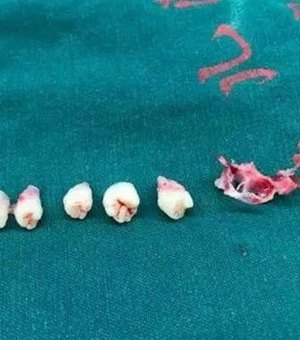 Dentes são removidos de cérebro de menino de 5 anos
