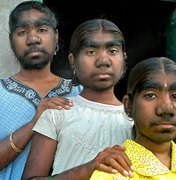 Mutação genética transforma três irmãs indianas em mulheres barbadas