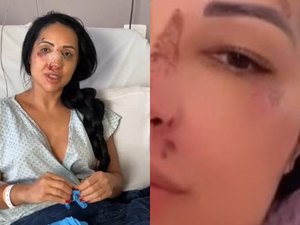 Irmã de Deolane retira curativo após estraçalhar nariz em briga e passar por cirurgia