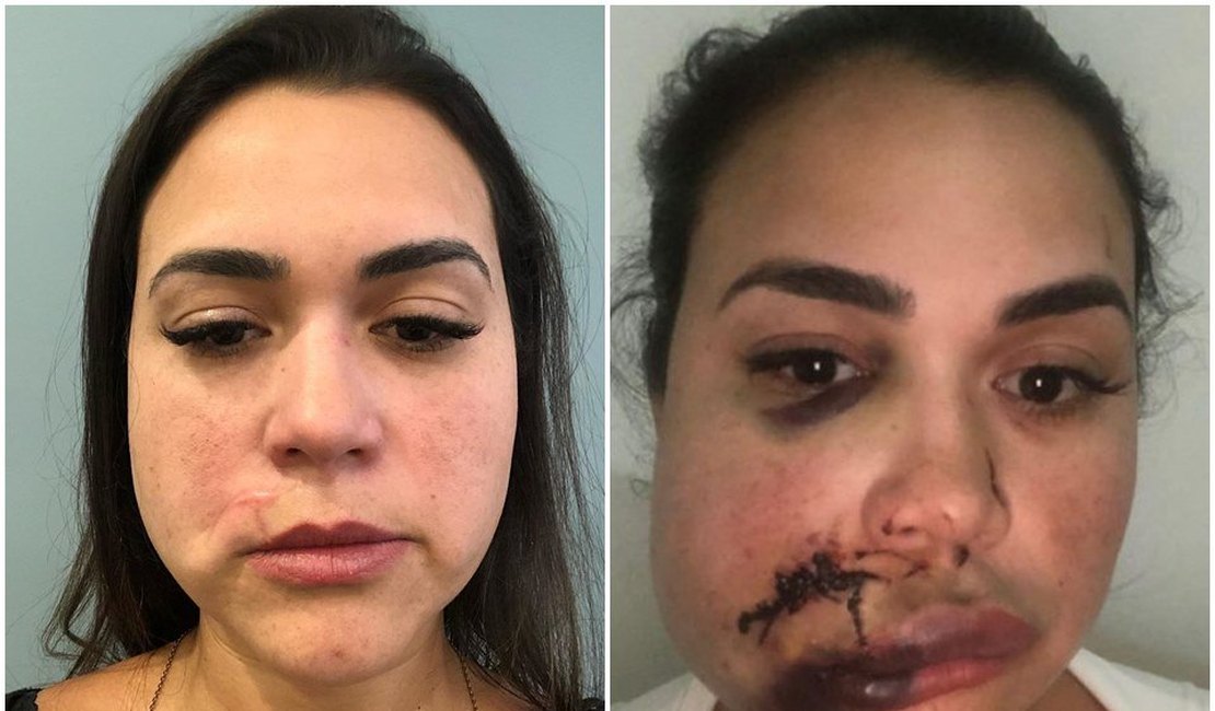 Milka Borges recebe laudo de cicatriz um ano após agressão: “Irreversível”