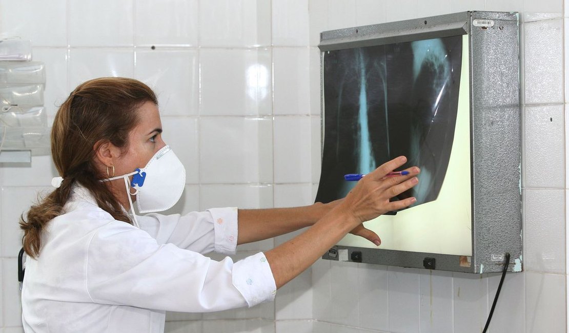 Governo Federal cria comitê contra tuberculose; casos aumentam em Alagoas