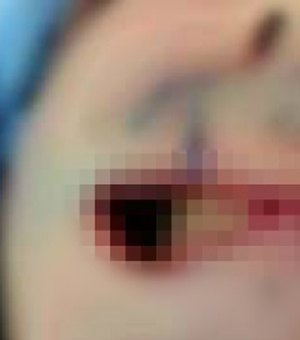 Homem é preso acusado de arrancar lábios da esposa com mordida, em Delmiro