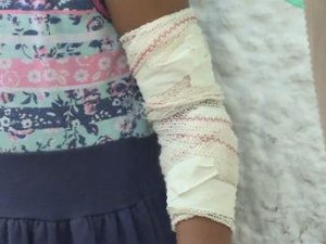 Tio é suspeito de queimar braço de sobrinha de 3 anos com sanduicheira