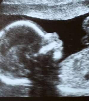 A delicada cesariana feita em bebê para retirar feto 'gêmeo'