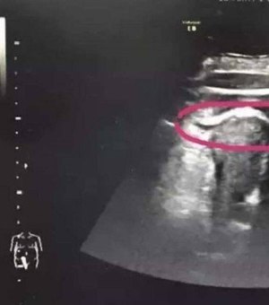 Mulher grávida quase morre após ‘chute’ do bebê romper o útero