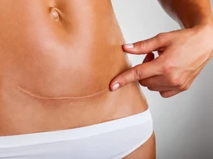 Mulher é internada com infecção após pontos de cesárea improvisada abrirem