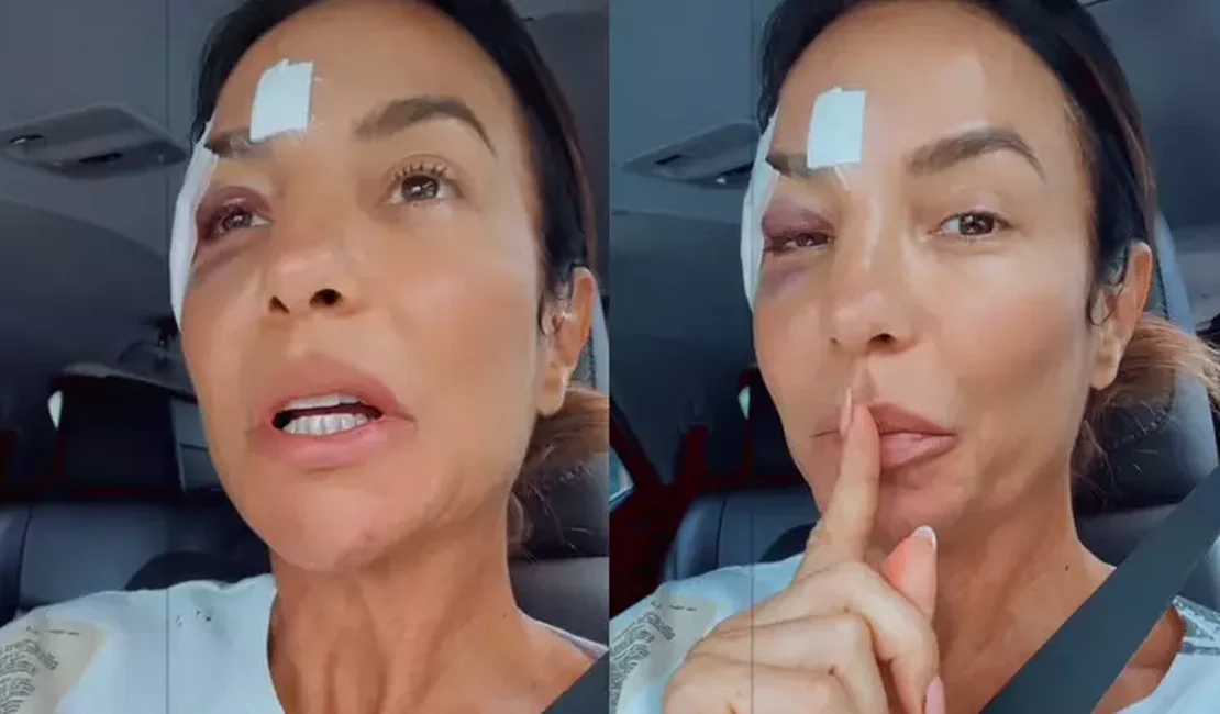 Com olho roxo, Ivete recebe alta de hospital em Salvador e explica quadro de saúde