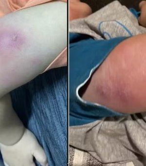 Bebê recebe alta após infecção grave pós-vacina em posto de saúde de Maceió