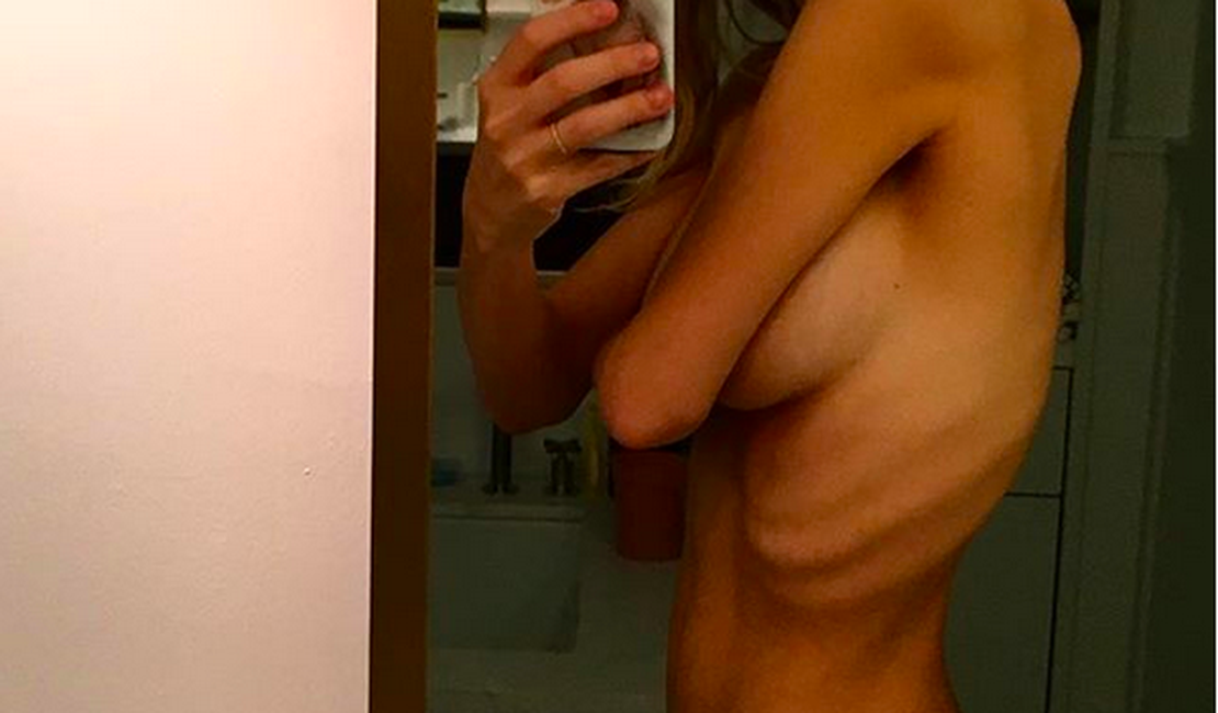 Mulher de astro de 'American Pie' assusta com selfie nua mostrando só pele e osso e desabafa sobre doença