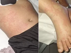 Menina de 10 anos luta contra infecção após contato com detergente Ypê