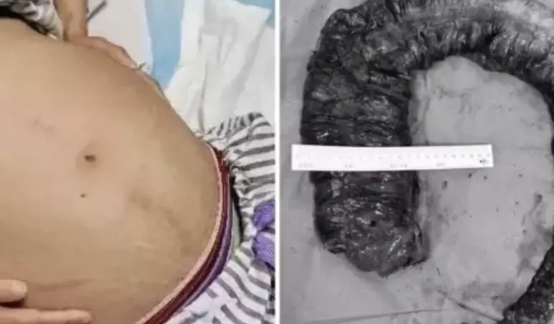Médicos tiram cocô de 20 kg de intestino de mulher que ficou 10 dias sem evacuar