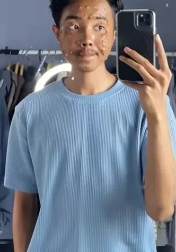 Homem contrai infecção viral após usar roupa de brechó sem lavar