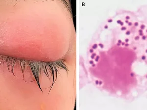 Infecção sexualmente transmissível pode afetar os olhos; entenda