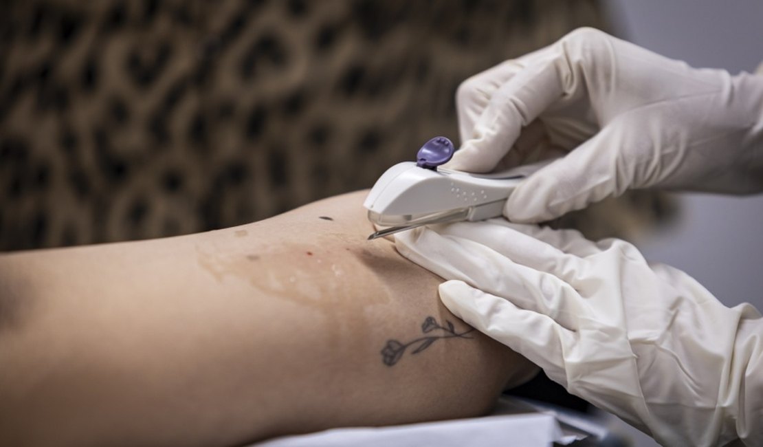 Em dois meses, Implanon é disponibilizado para mais de 600 mulheres