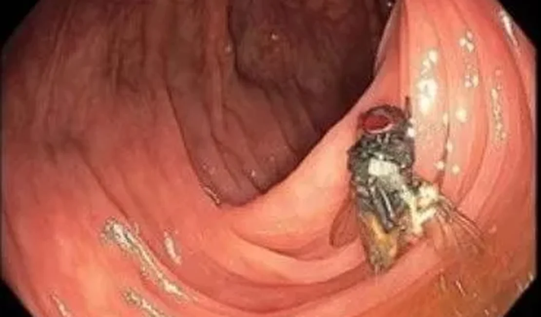 Médicos encontram mosca viva dentro de intestino de paciente durante exame