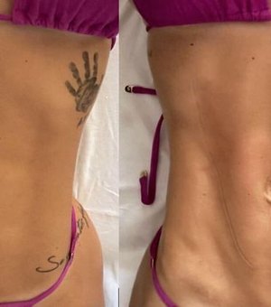 Virginia Fonseca mostra a barriga antes e depois de fazer massagem modeladora