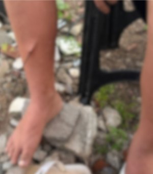 Criança de 10 anos é levada ao HEA após ter perna perfurada por vergalhão em Arapiraca