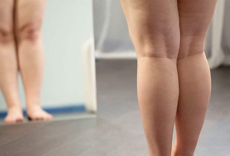 Lipedema: Muito Além da 'celulite'; entenda a condição