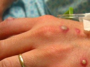 Primeiro caso de varíola dos macacos no Brasil é confirmado na cidade de SP