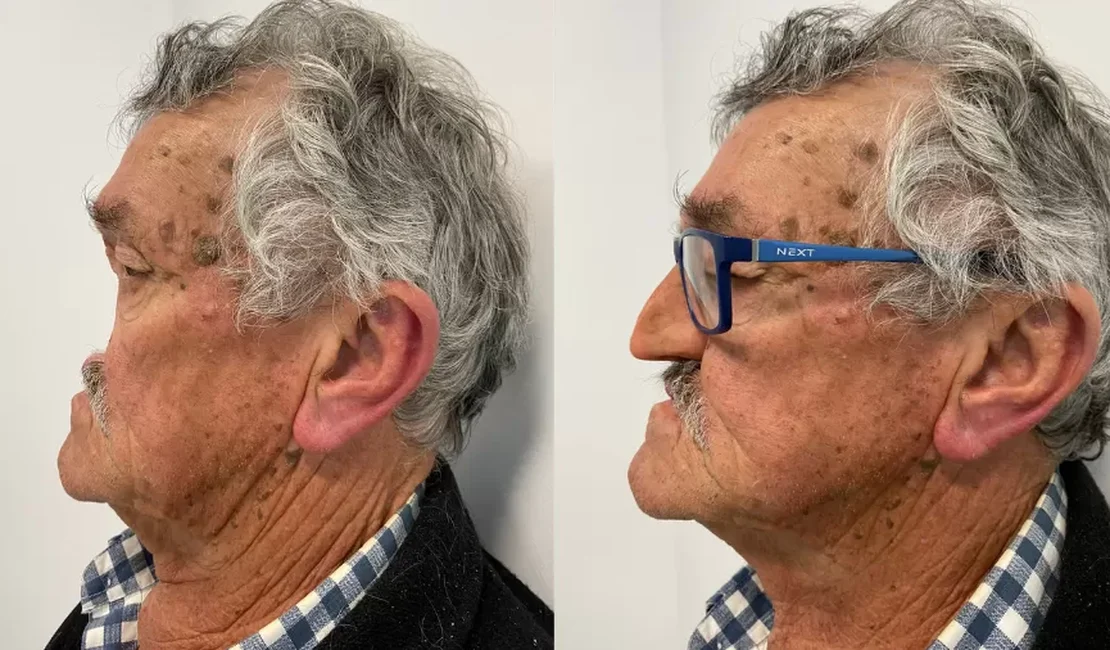 'Vivi 2 anos sem nariz, mas uma prótese facial ajudou a me reerguer'