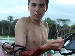 Surfista é atacado por tubarão mesmo usando braçadeira de proteção