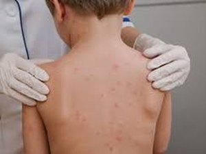 Prefeitura tranquiliza pais e mães de que não há casos de meningite no município