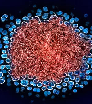 Homem tem remissão do HIV após transplante inédito de medula óssea do irmão