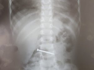 Criança de três anos engole prego e pais ficam desesperados
