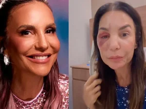 Ivete Sangalo mostra rosto com hematoma e esclarece estado de saúde