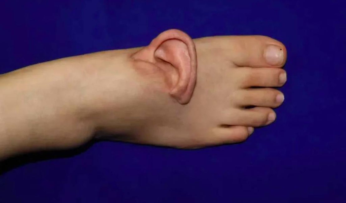 Médicos chineses enxertam orelha em pé de paciente