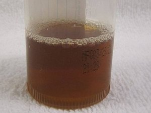 Doença que deixa urina preta acende alerta e Sesau diz estar vigilante em Alagoas