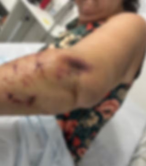 Turista atacada por três cães na orla de Paripueira perde movimentos dos dedos