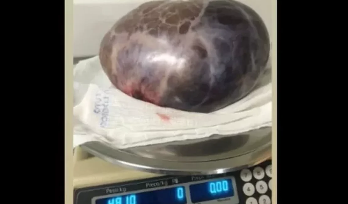 Em cirurgia de emergência, médicos retiram tumor de 5 kg de paciente