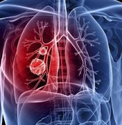 Maceió registra mais de 2,5 mil mortes por câncer de pulmão