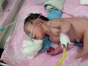 Índia registra nascimento de 'bebê-sereia', que atrai multidão a maternidade