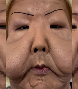 Juju do Pix mostra como ficou o rosto deformado após cirurgia