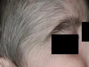 Minoxidil: produto anticalvície usado pelo pai fez crescer pelos em bebês