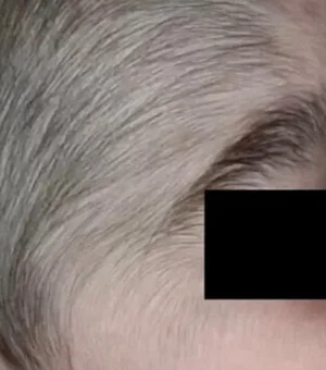 Minoxidil: produto anticalvície usado pelo pai fez crescer pelos em bebês