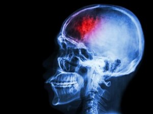 Saiba mais sobre o AVC; quase 1.700 foram atendidos com derrame no HGE