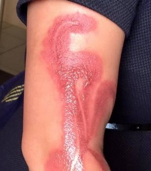 Mulher tem braço queimado após dormir sobre iPhone 7