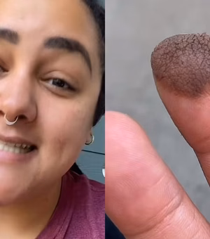 Mulher precisa depilar dedo após fazer enxerto com pele da virilha